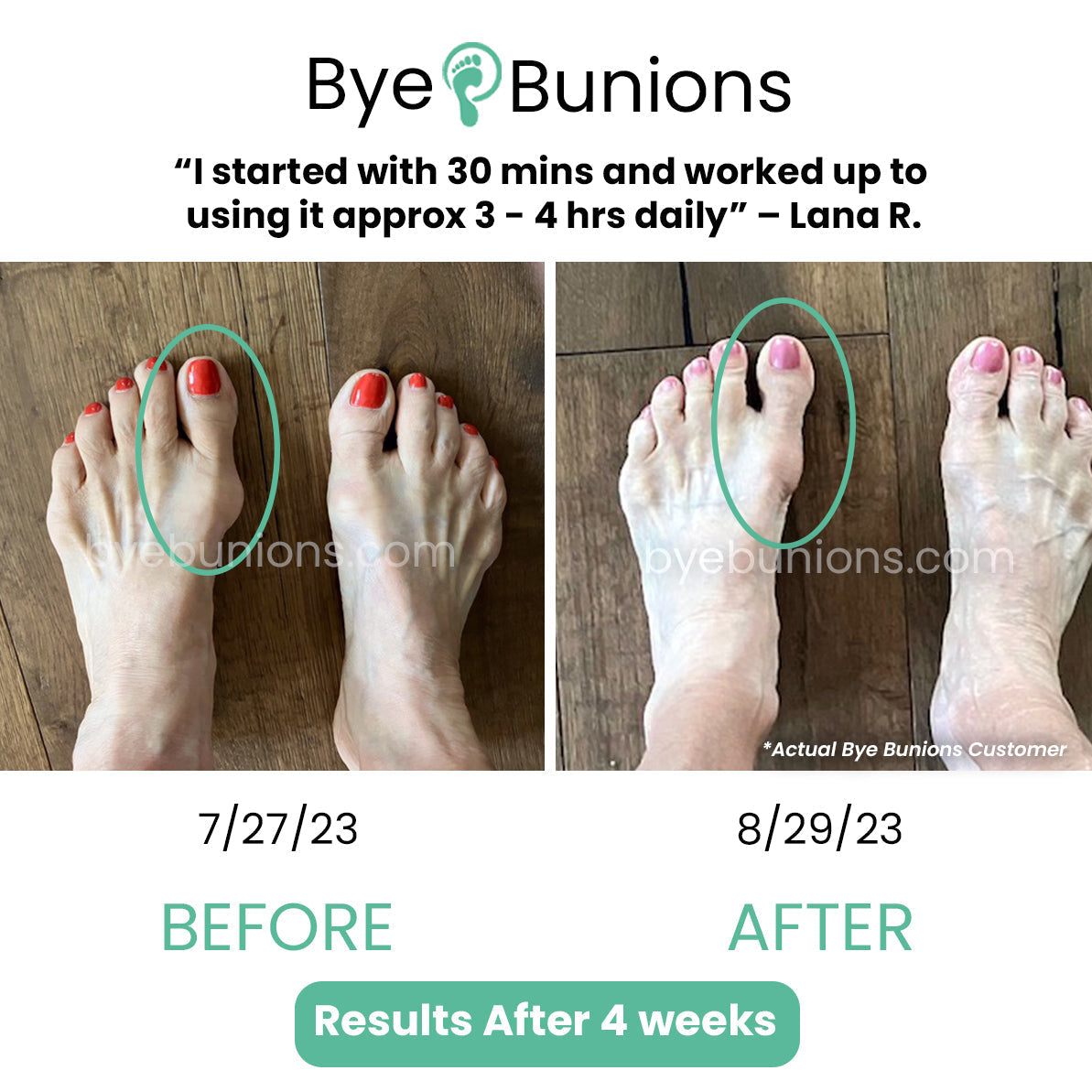 Bunion Fixed Splint (50% Off)